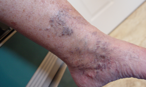 Bspider Chronic Venous Insufficiency