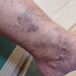 Spider Veins Spider Veins