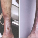Venous Stasis Leg Ulcer Treatment