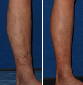 Before and After Varicose Vein Treatment