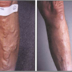Before and After Varicose Vein Treatment