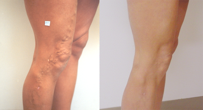 Risks of Improperly Treated Varicose Veins