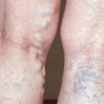 Spider Veins and Varicose Veins