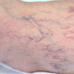 Spider Veins