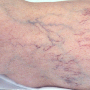 Spider Veins