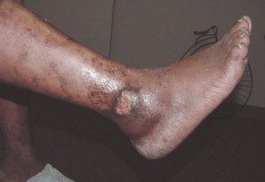 Venous Leg Ulcer