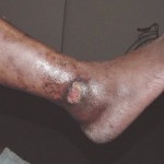 Venous Leg Ulcer