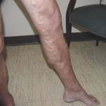 Varicose Veins