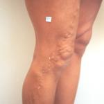 Varicose Veins Treatment and Treatment for Spider Veins on Legs at VSA Vein Treatment Center