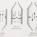 Incompetent veins diagram Incompetent veins diagram