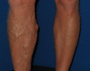 Varicose Veins Before Treatment