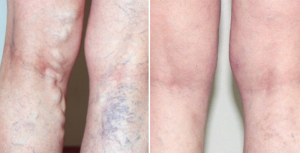 Before and After Spider Vein and Varicose Vein Treatment