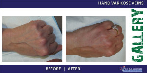 hand_varicoseveins