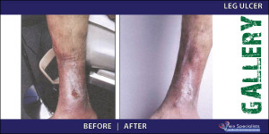 leg_ulcer