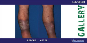leg_ulcer2