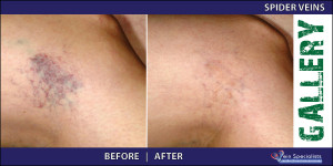 spiderveins_1