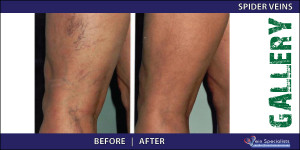 spiderveins_2