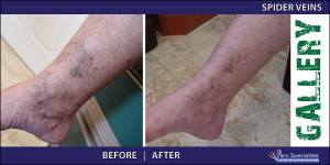 spiderveins_3