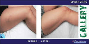 spiderveins_5