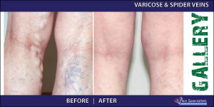 varicosespiderveins_2