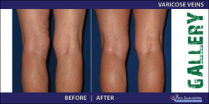 varicoseveins_1