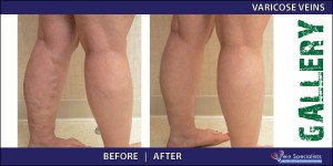 varicoseveins_2