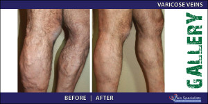 varicoseveins_3