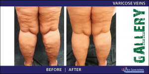 varicoseveins_4