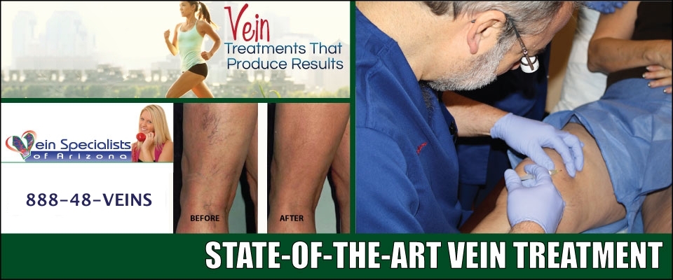 laser spider vein treatment and sclerotherapy