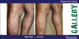 Vein Treatment Gallery