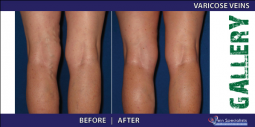 Vein Treatment Gallery | Welcome to Vein Specialists of Arizona 2016-02-29 20-51-30