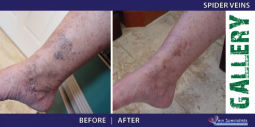 Vein Treatment Gallery | Welcome to Vein Specialists of Arizona 2016-02-29 20-52-23