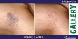 Vein Treatment Gallery | Welcome to Vein Specialists of Arizona 2016-02-29 20-55-29