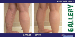 Vein Treatment Gallery | Welcome to Vein Specialists of Arizona 2016-02-29 20-59-01