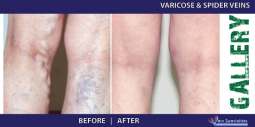 Vein Treatment Gallery | Welcome to Vein Specialists of Arizona 2016-02-29 21-00-27