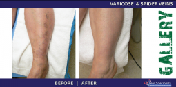 Vein Treatment Gallery | Welcome to Vein Specialists of Arizona 2016-02-29 21-00-56