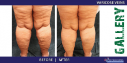 Vein Treatment Gallery | Welcome to Vein Specialists of Arizona 2016-02-29 21-01-12