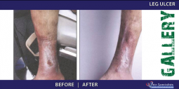 Vein Treatment Gallery | Welcome to Vein Specialists of Arizona 2016-02-29 21-02-09