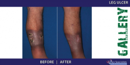 Vein Treatment Gallery | Welcome to Vein Specialists of Arizona 2016-02-29 21-02-27