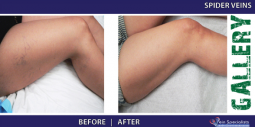 Vein Treatment Gallery | Welcome to Vein Specialists of Arizona 2016-02-29 21-02-47